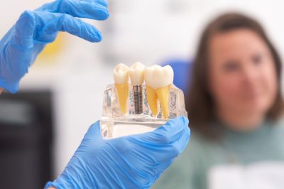 close-up-of-dental-model-with-implant-patient-of-2024-11-27-17-58-45-utc