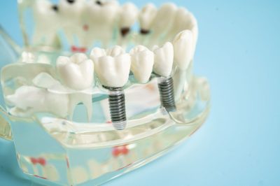 dental-implant-artificial-tooth-roots-into-jaw-r-2025-02-24-18-02-32-utc