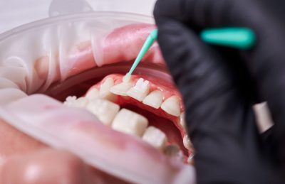 dentist-s-hand-wearing-black-glove-brushing-lower-2025-01-16-23-08-07-utc