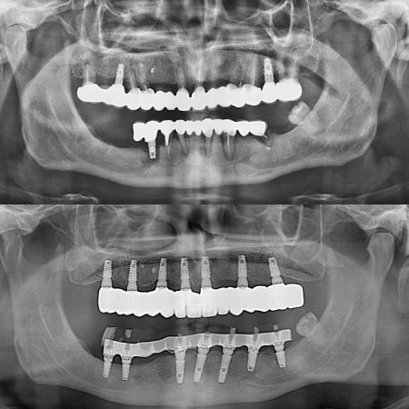 implant